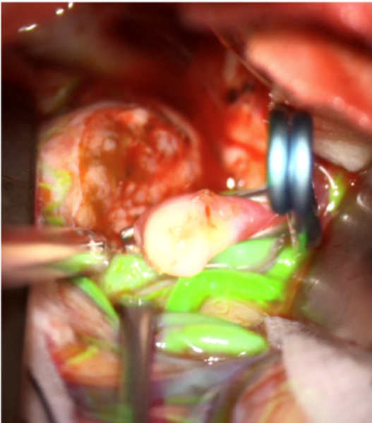 Grüne Stellen in einem Gehirn zeigen, wo ein Anerysma abgeklemmt wurde in der Neurochirurgie.